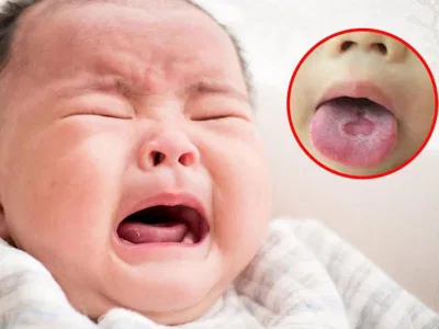 Trẻ bị tưa miệng phải làm sao? (Nguồn: Internet) Trẻ bị tưa miệng phải làm sao? (Nguồn: Internet)