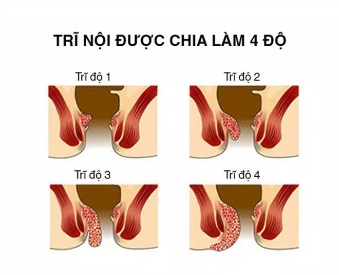 Nguyên nhân gây ra trĩ nội (Nguồn: Internet) Nguyên nhân gây ra trĩ nội (Nguồn: Internet)