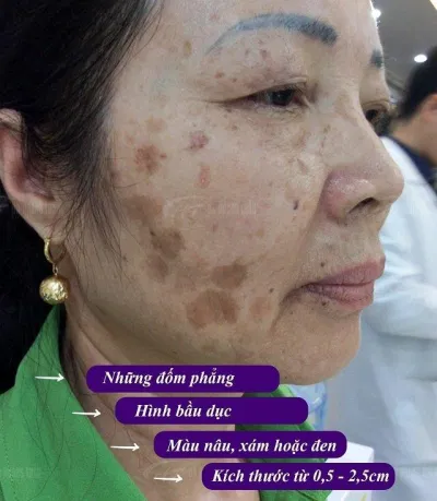 Đồi mồi là gì?( Nguồn: Internet) Đồi mồi là gì?( Nguồn: Internet)