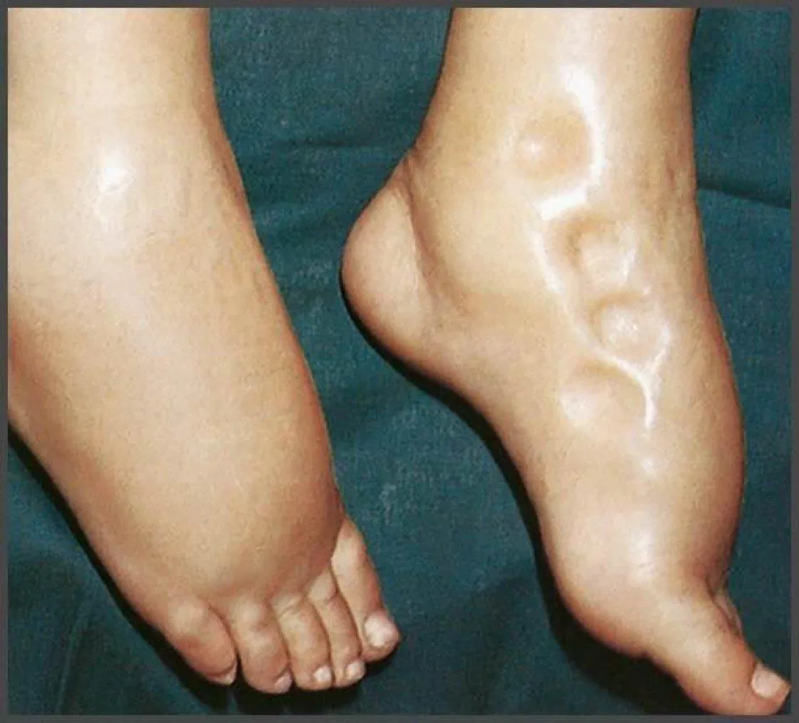 Sưng phù chi dưới khi tim hoạt động không bình thường (Ảnh: Internet)