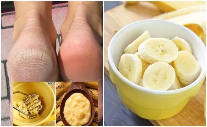 Vitamin trong chuối giúp làm hồng gót chân hiệu quả (Nguồn: Internet) Vitamin trong chuối giúp làm hồng gót chân hiệu quả (Nguồn: Internet)