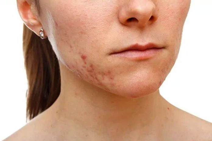 Những vết thương trên da nếu bị tác động nhiều cũng sẽ khiến cho da bị tăng sắc tố (Ảnh: Internet)