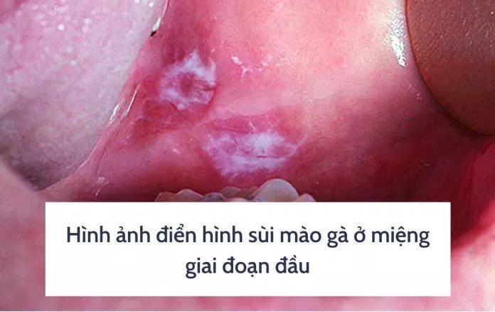 Hình ảnh sùi mào gà ở miệng (Nguồn: Internet) Hình ảnh sùi mào gà ở miệng (Nguồn: Internet)