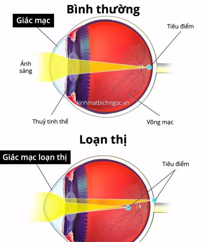 Mắt bị loạn thị so với mắt bình thường (Ảnh: Internet) Mắt bị loạn thị so với mắt bình thường (Ảnh: Internet)