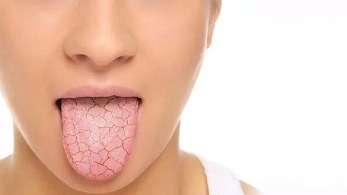 Uống nhiều nước hơn khi cảm thấy khô miệng (Nguồn: Internet) Uống nhiều nước hơn khi cảm thấy khô miệng (Nguồn: Internet)