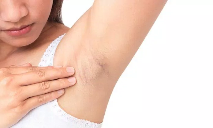 Wax hoặc nhổ lông không đúng cách sẽ khiến bạn bị viêm nang lông (Ảnh: Internet)