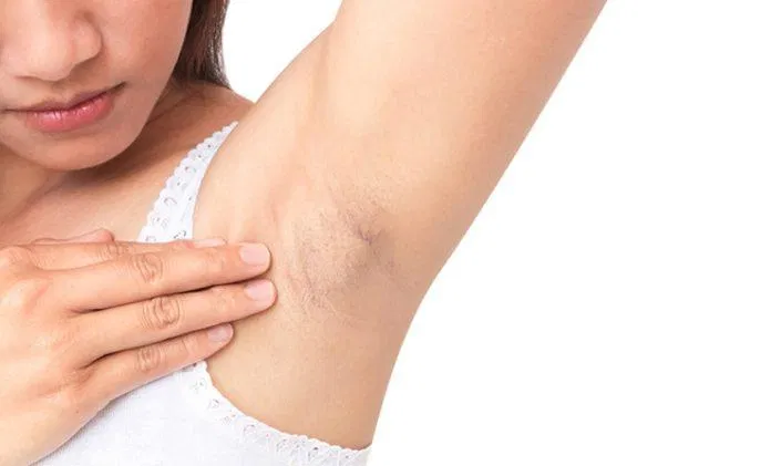 Wax hoặc nhổ lông không đúng cách sẽ khiến bạn bị viêm nang lông (Ảnh: Internet)