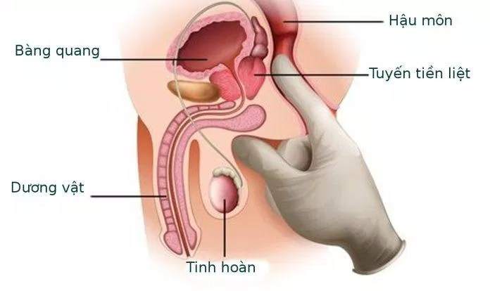Định nghĩa về ung thư tuyến tiền liệt? (Nguồn: Internet) Định nghĩa về ung thư tuyến tiền liệt? (Nguồn: Internet)