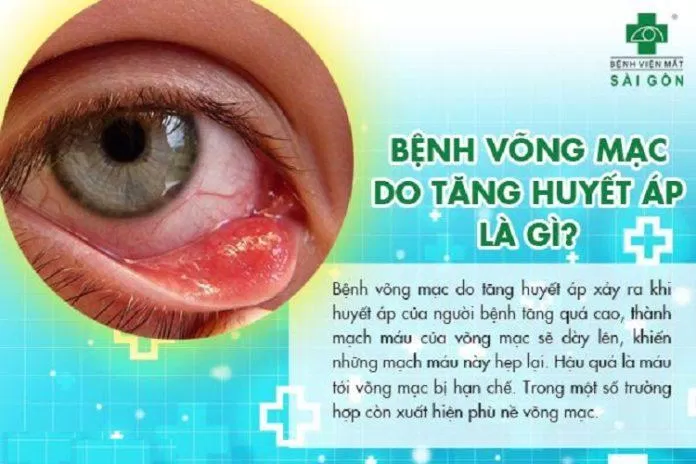 Bệnh võng mạc do tăng huyết áp (Ảnh: Internet) Bệnh võng mạc do tăng huyết áp (Ảnh: Internet)