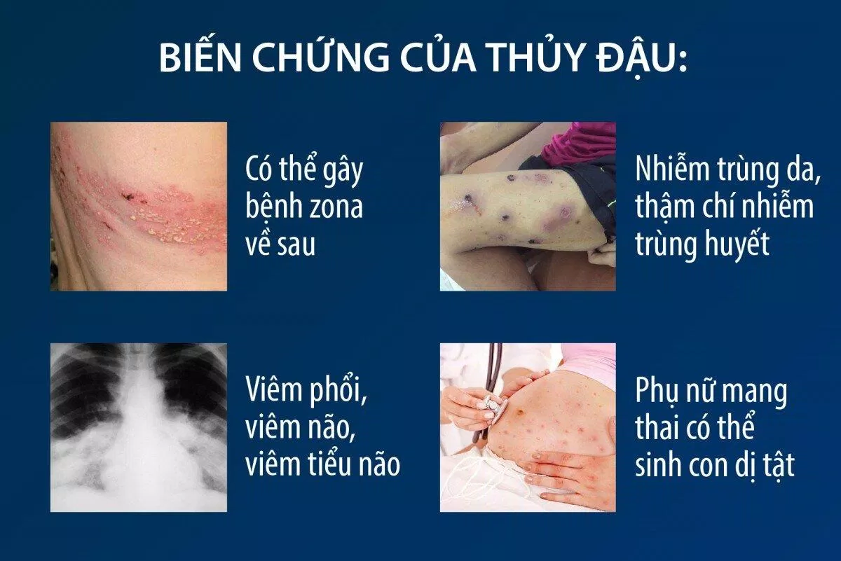 Biến chứng của thuỷ đậu (Nguồn: Internet)