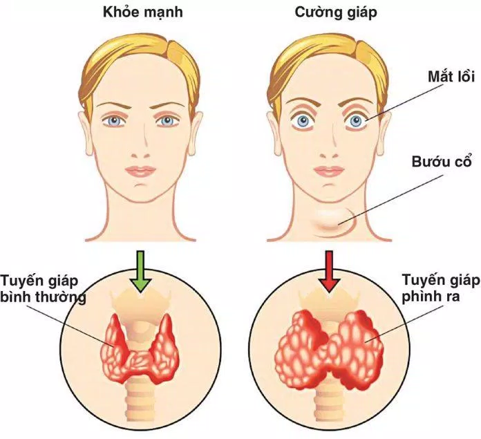 Bệnh tuyến giáp có những dấu hiệu như thế nào? (Nguồn: Internet) Bệnh tuyến giáp có những dấu hiệu như thế nào? (Nguồn: Internet)
