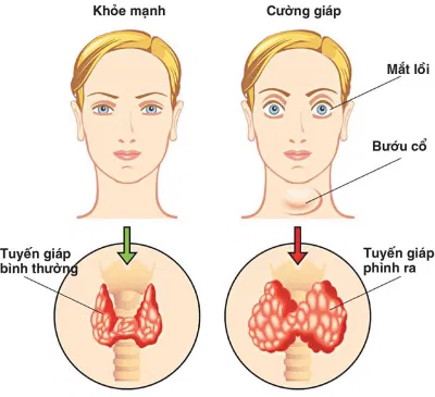 Bệnh tuyến giáp có những dấu hiệu như thế nào? (Nguồn: Internet) Bệnh tuyến giáp có những dấu hiệu như thế nào? (Nguồn: Internet)