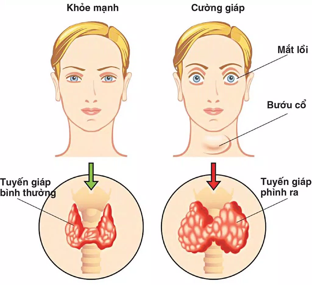 Bệnh tuyến giáp có những dấu hiệu như thế nào? (Nguồn: Internet)