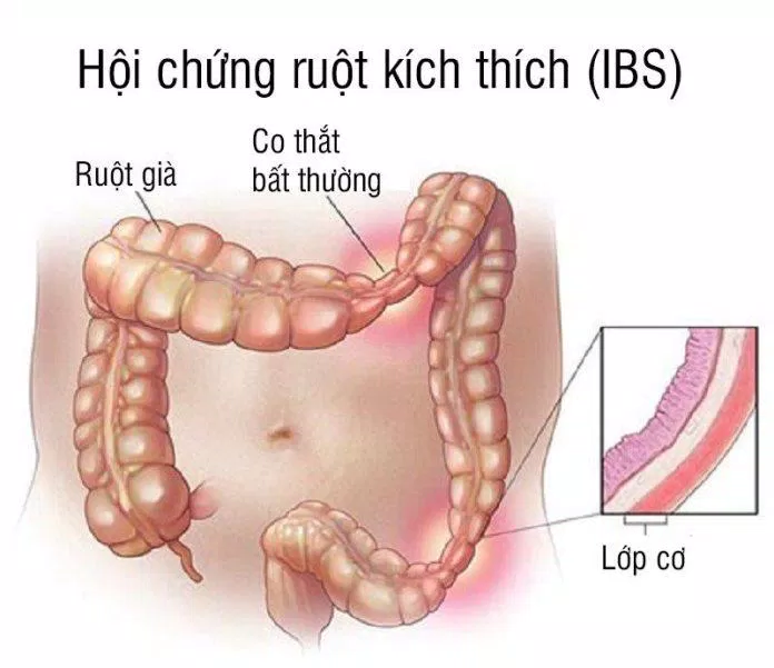 Định nghĩ về hội chứng ruột kích thích( Nguồn: Internet) Định nghĩ về hội chứng ruột kích thích( Nguồn: Internet)