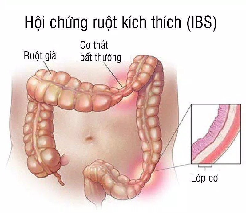 Định nghĩ về hội chứng ruột kích thích( Nguồn: Internet) Định nghĩ về hội chứng ruột kích thích( Nguồn: Internet)