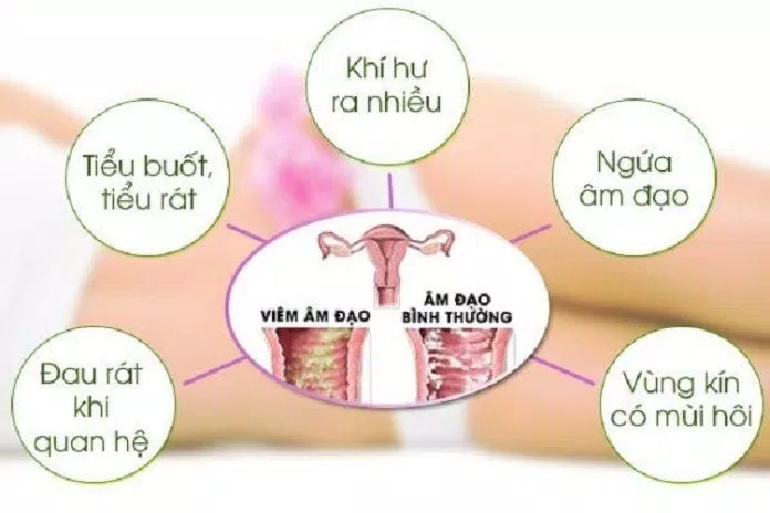 Triệu chứng viêm âm đạo (Ảnh: Internet) Triệu chứng viêm âm đạo (Ảnh: Internet)