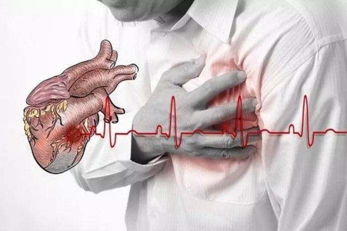 Biểu hiện của nhồi máu cơ tim (Nguồn: Internet)