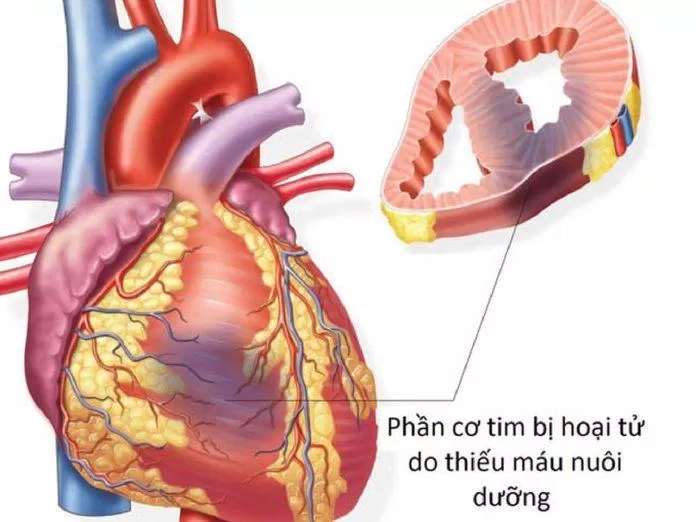 Nhồi máu cơ tim (Nguồn: Internet) Nhồi máu cơ tim (Nguồn: Internet)