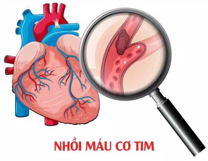 Nhồi máu cơ tim (Nguồn: Internet) Nhồi máu cơ tim (Nguồn: Internet)