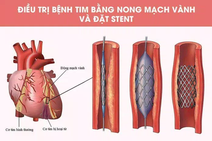 Những lưu ý cho người bị nhồi máu cơ tim( Nguồn: Internet) Những lưu ý cho người bị nhồi máu cơ tim( Nguồn: Internet)