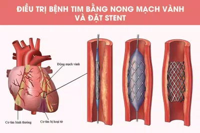 Những lưu ý cho người bị nhồi máu cơ tim( Nguồn: Internet)