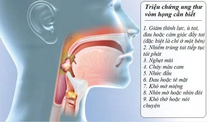 Triệu chứng của ung thư vòm họng (Nguồn: Internet) Triệu chứng của ung thư vòm họng (Nguồn: Internet)