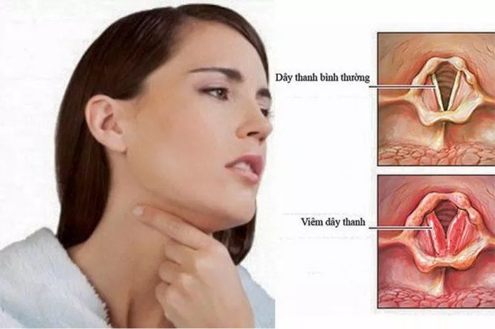 Biện pháp để bảo vệ thanh quản hàng ngày (Nguồn: Internet) Biện pháp để bảo vệ thanh quản hàng ngày (Nguồn: Internet)