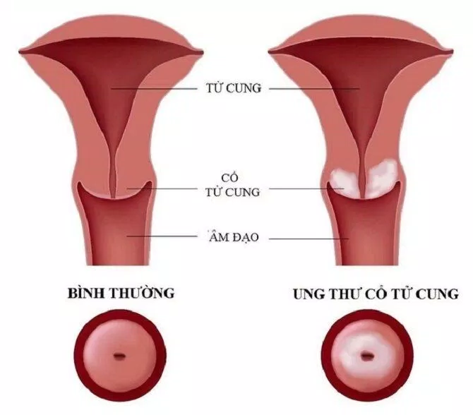 Khái niệm về bệnh u nang tử cung( Nguồn: Internet)