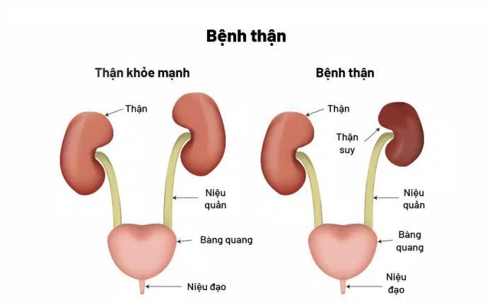 Bệnh thận mạn (Nguồn: Internet) Bệnh thận mạn (Nguồn: Internet)