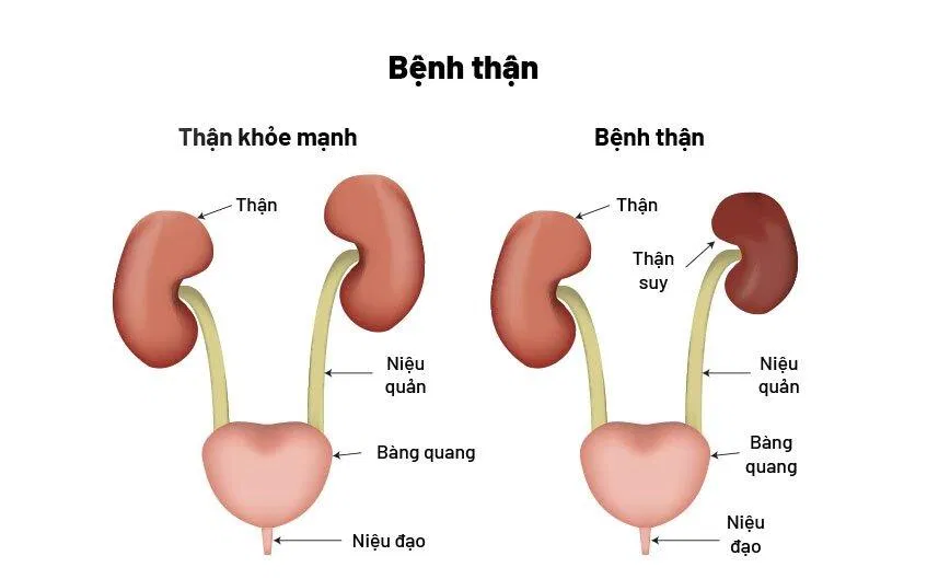Bệnh thận mạn (Nguồn: Internet) Bệnh thận mạn (Nguồn: Internet)