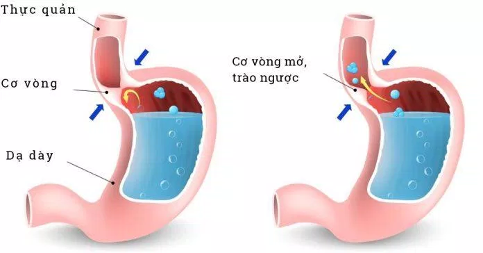 Biến chứng sau phẫu thuật cắt dạ dày (Nguồn: Internet) Biến chứng sau phẫu thuật cắt dạ dày (Nguồn: Internet)