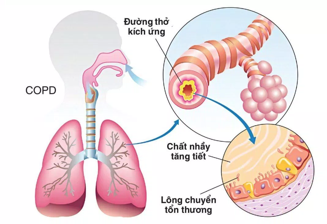 Dinh dưỡng trong bệnh phổi tắc nghẽn mạn tính (COPD) (Nguồn: Internet)