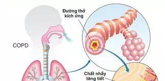 Dinh dưỡng trong bệnh phổi tắc nghẽn mạn tính (COPD) (Nguồn: Internet)