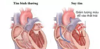 Dinh dưỡng trong bệnh suy tim (Nguồn: Internet)