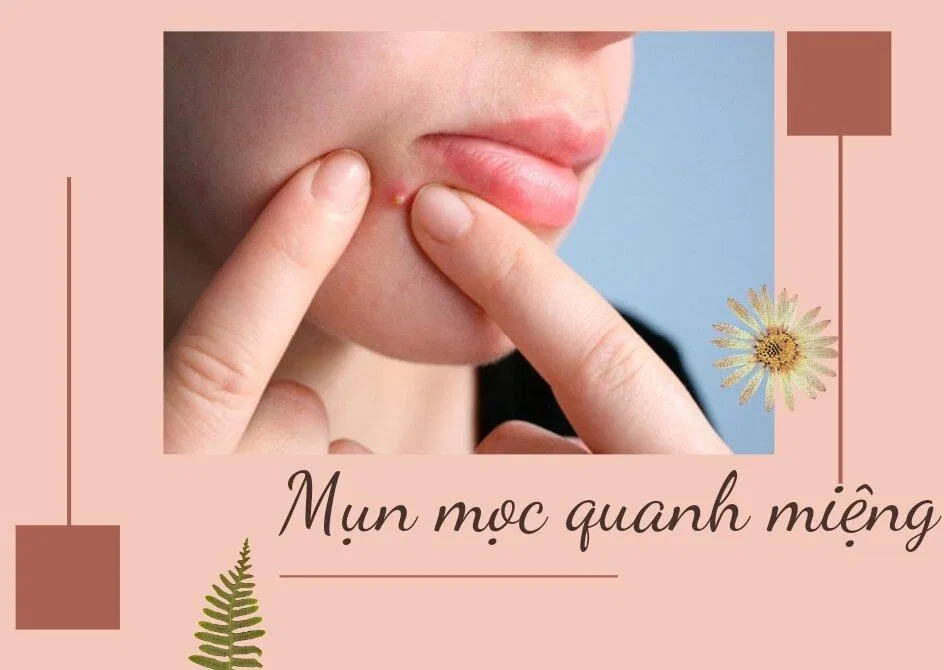 Dấu hiệu của tay chân miệng (Nguồn: Internet) Dấu hiệu của tay chân miệng (Nguồn: Internet)