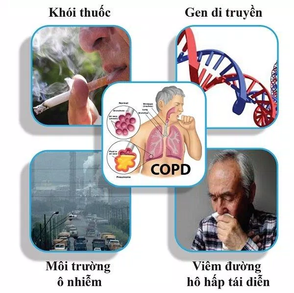 Nguyên nhân gây bệnh COPD (Nguồn: Internet) Nguyên nhân gây bệnh COPD (Nguồn: Internet)