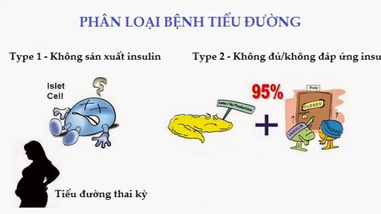 Phân loại bệnh tiểu đường (Nguồn: Internet).