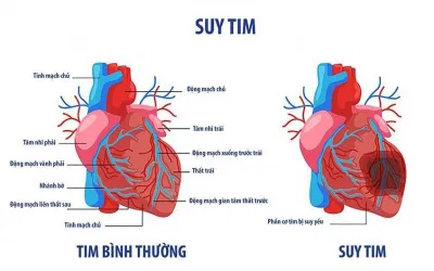 Tim bình thường so với suy tim (Nguồn: Internet) Tim bình thường so với suy tim (Nguồn: Internet)