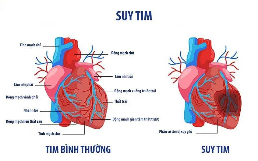 Tim bình thường so với suy tim (Nguồn: Internet)