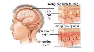 Các tác nhân gây ra viêm màng não (Nguồn: Internet)