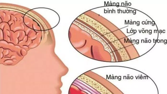 Nguyên nhân gây ra viêm màng não (Nguồn: Internet) Nguyên nhân gây ra viêm màng não (Nguồn: Internet)