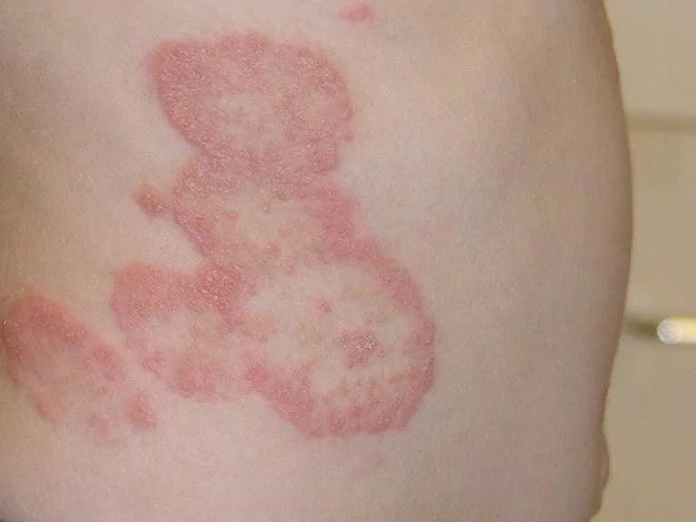 Các loại nấm thường gặp ở người. (Nguồn: Internet) Các loại nấm thường gặp ở người. (Nguồn: Internet)