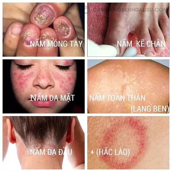 Các loại nấm da (Nguồn: Internet) Các loại nấm da (Nguồn: Internet)
