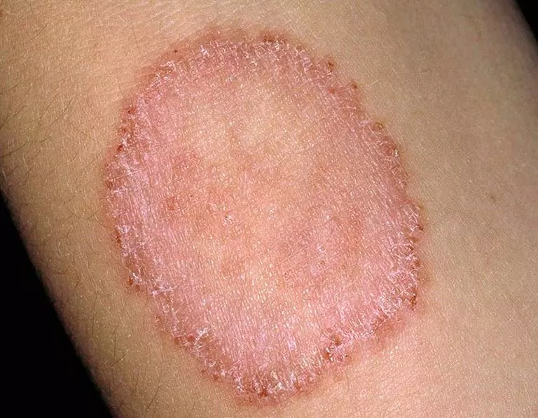 Sử dụng đồ dùng với bệnh nhân nấm da (Nguồn: Internet) Sử dụng đồ dùng với bệnh nhân nấm da (Nguồn: Internet)