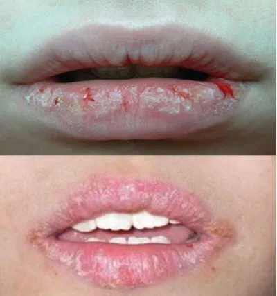Các bệnh dễ gặp khi phun xăm không uy tín. ( Nguồn: Internet) Các bệnh dễ gặp khi phun xăm không uy tín. ( Nguồn: Internet)