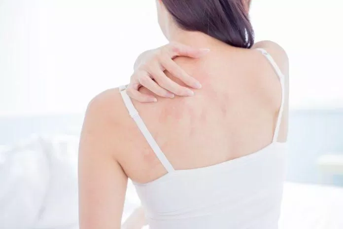 Nguyên nhân gây ra mụn lưng