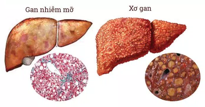 Phân biệt gan nhiễm mỡ và xơ gan (Nguồn: Internet)