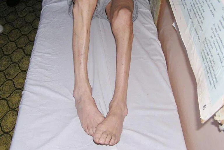 Dấu sao mạch (Nguồn: Internet)