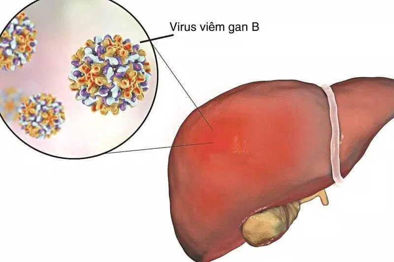 Viêm gan siêu vi B (Nguồn: Internet)