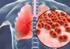 Giảm nguy cơ mắc bệnh viêm phổi (ảnh: Internet)